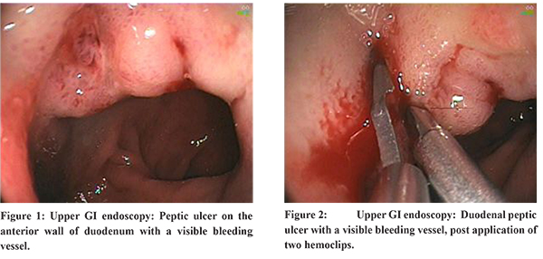 Esophageal thrush deals